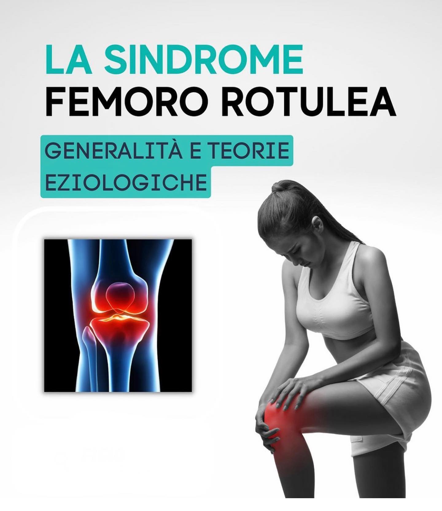 È chiamata Sindrome Femoro-Rotulea